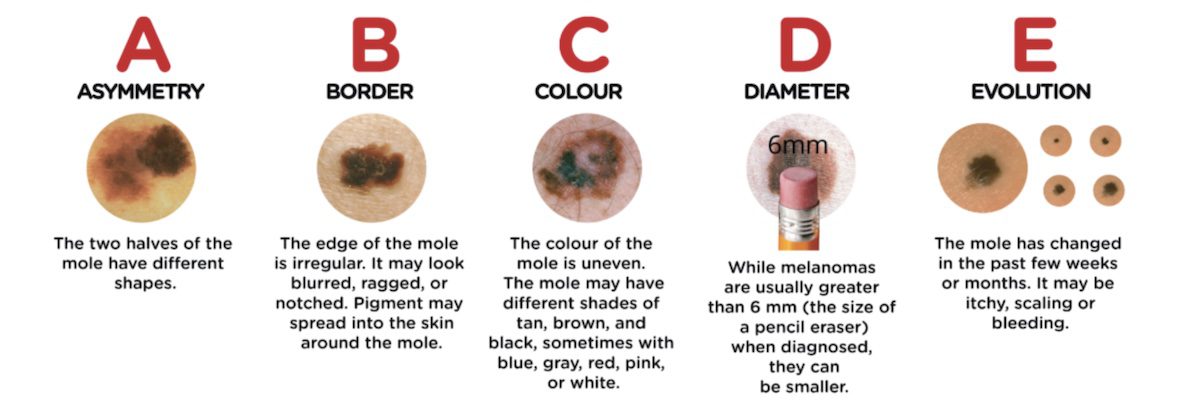 Prevent Melanoma ABCDE Chart